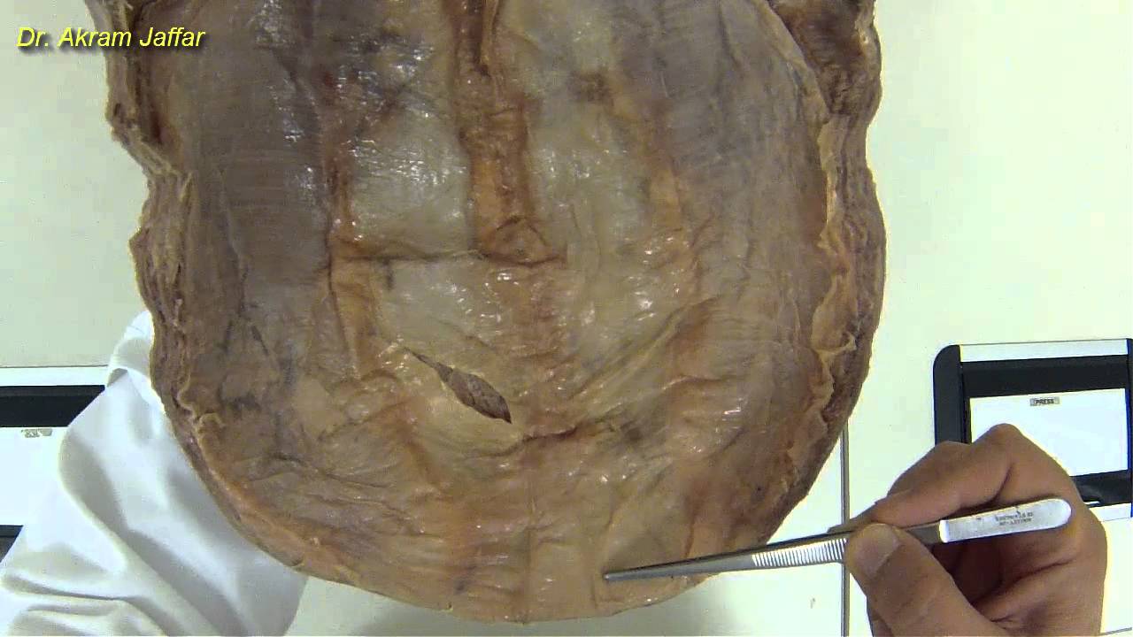 Peritoneal folds of anterior abdominal wall - YouTube