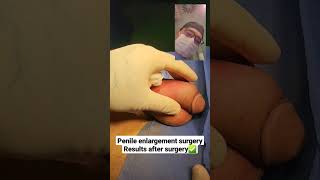Penile Enlargement Surgery - Results After Surgery - Dr. Araz Bayramov - Penilenlargement