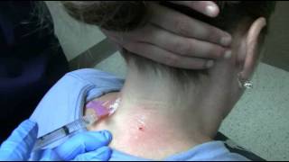 Cervical transforaminal epidural steroid injection side effects