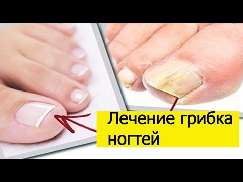 Средство от ногтевого грибка в домашних условиях Средство от ногтевого грибка в домашних условиях