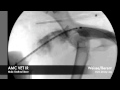 Interventional Radiology: Urethral Stent - Male