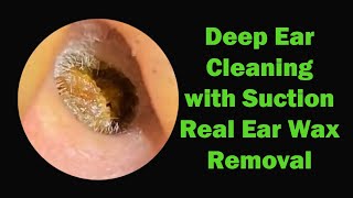 Deep Ear Cleaning With Suction Real Sound Ear Wax Removal