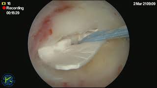 Rotator Cuff Repair of a Full-Thickness Tear with the Rotium™ Bioabsorbable Wick and Mitek DynaCord™