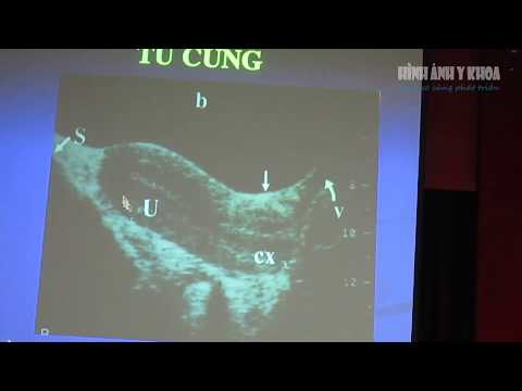 Siêu âm âm đạo, cổ tử cung, tử cung, Bs Hà Tố Nguyên