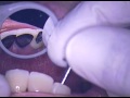 DR. GERARD CUOMO - Implant Dentistry - Straumann NC BL open tray transfer abutment 1 - Florida