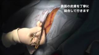 背部刺青分割切除 山本クリニック