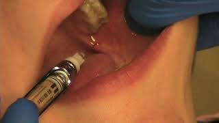 Techniques For Successful Local Anesthesia