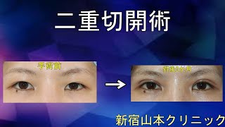 二重切開(二重形成) 山本クリニック
