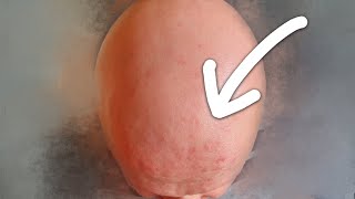 FOLICULITIS CRÓNICA CUERO CABELLUDO