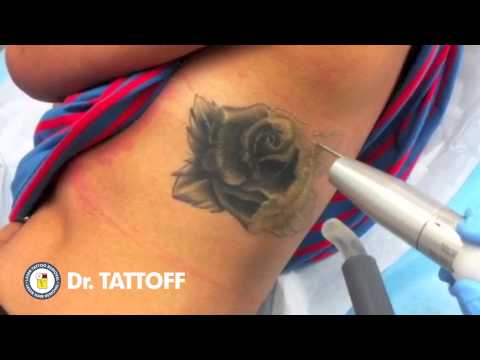 Tattoo Removal Houston Texas - Laser Tattoo Removal Procedure of Rose ...