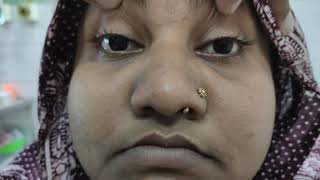 Relative Afferent Pupillary Defect Rapd