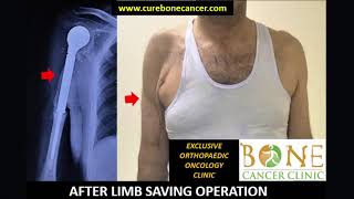 Limb Saving Surgery For Chondrosarcoma Arm Bone