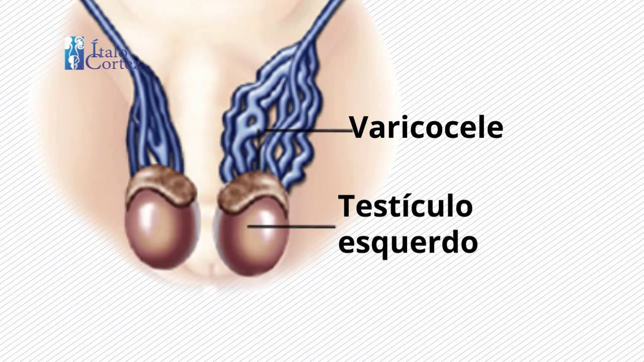 Sperm count after varicoceles surgery