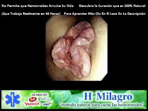 El tratamiento varikoza por la sosa alimenticia