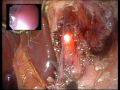 8322GS Single Incision Laparoscopic Heller Myotomy and Anterior Fundoplication