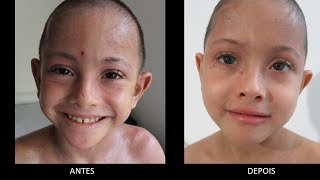 Daniel - Dermatite atópica