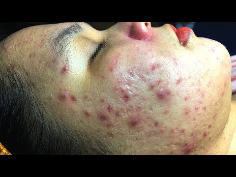 Help The Girl's Skin Recover | Giải Cứu Làn Da Nhiều Mụn Cho Cô Gái