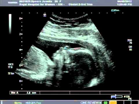 19 week ultrasound cleft lip Part 1 of 4 - YouTube