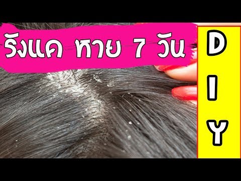 สุดเจ๋ง หยุดปัญหารังแค คันหนังศรีษะ ผมร่วงเป็นหย่อมๆๆภายใน 7 วัน l Easy home