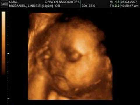 3d ultrasound pictures of twins. 3d ultrasound pictures of twins. Ava Mae McDaniel 3D Ultrasound; Ava Mae McDaniel 3D Ultrasound. shawnce. Aug 1, 10:00 AM