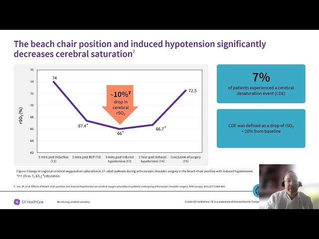 Watch Monitoring cerebral oximetry: Orthopedic patients undergoing shoulder procedures in the beach chair on YouTube.