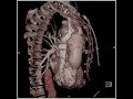 MDCT 64: Aortic Aneurysm VRT