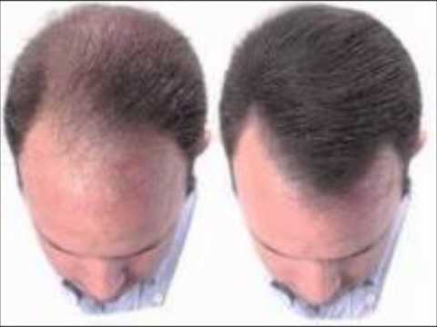 Propecia minoxidil regrowth Propecia minoxidil regrowth