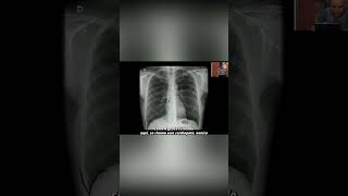 Seio-Cardiofrenico