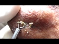 Comedolytics & Extraction