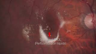 Removal Of Submacular Perfluorocarbon Liquids With A 38-Gauge Cannula Subretinal Pfcl