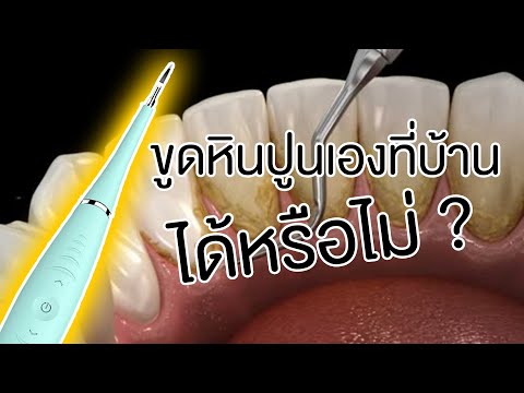 ขูดหินปูนเองที่บ้าน ด้วยเครื่องขูดหินปูนใน internet...ได้หรือไม่ ? | โชคช่วย กับหมอโชค