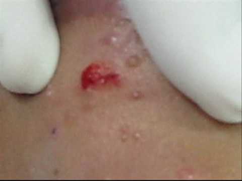 treatment of molluscum contagiosum wmv molluscum contagiosum is the 