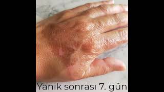 Yanikta Aromaterapi̇k Yağlar