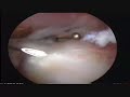 Arthroscopic Release of Calcific Deosit of Shoulder