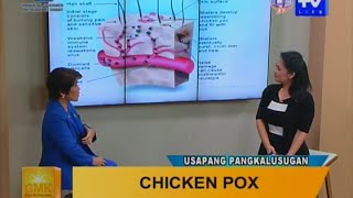 Good Morning Kuya Chicken Pox - Symptoms And Treatment