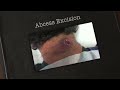 Abscess Excision