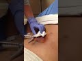 Severely infected lower back abscess incision and drainage (explicit content)