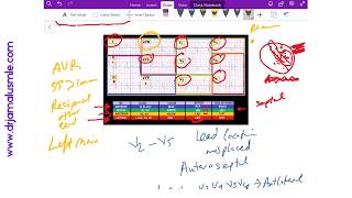 STEMI location on ECG - Dr Jamal USMLE - Cardiology ECG lecture