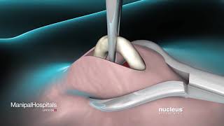 Vasectomy Is The Birth Control Method For Men - Manipal Hospital Vasectomy Is The Birth Control Method For Men - Manipal Hospital