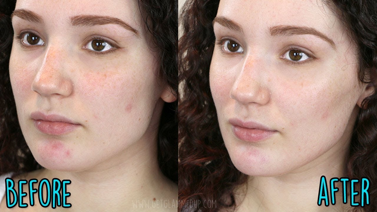 Diminish facial spots permanently