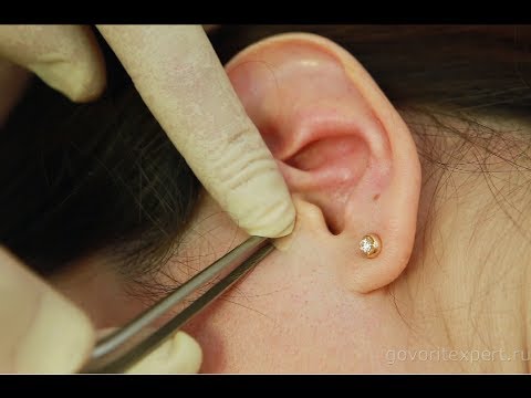 Оперативное лечение плоскостопия у детей