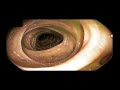 Colon, Benign Findings, Sigmoid Diverticulosis