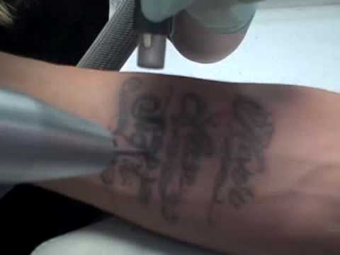 Tattoo Removal - Dr TATTOFF Opens 7th Laser Tattoo Removal Clinic Tattoo Removal - Dr TATTOFF Opens 7th Laser Tattoo Removal Clinic