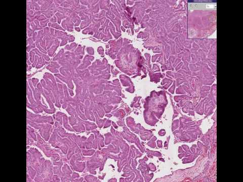 mother step daughter sex mayo clinic invasive basal breast cancer
