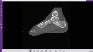 Impacto Tibiotalar Anterior