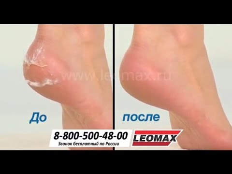 Как сделать ноги сухими Как сделать ноги сухими