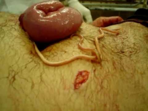 Sinais de vermes na criança 4 anos
