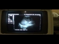 ultrasound of SPLENIC ABSCESS with LT PLEURAL EFFUSION