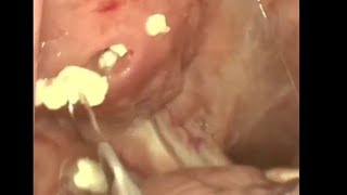 Tonsil Stones Reaction 14 You Can Use A Water Pick To Flush Tonsil Stones Out.