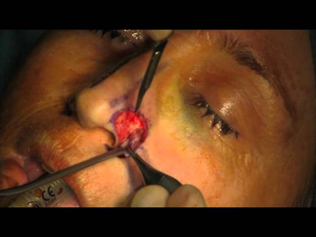 Nasal Ala Reconstruction with Nasolabial Flap and Ear Cartilage Graft, Stage I